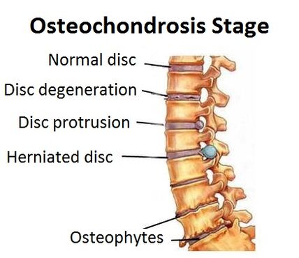 Stages of osteochondrosis