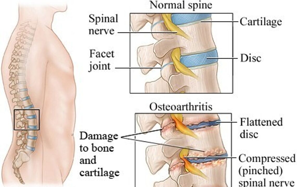 The difference between a healthy disk and a disc with osteochondrosis