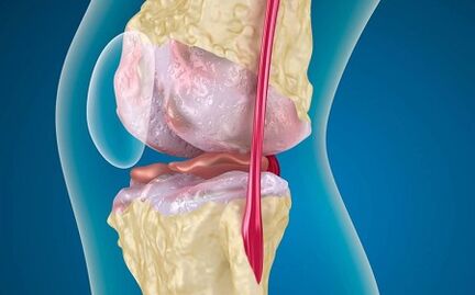 The reasons for the development of arthrosis of the knee joint