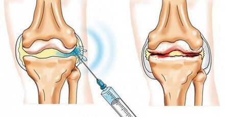 how to treat arthrosis of the knee joint